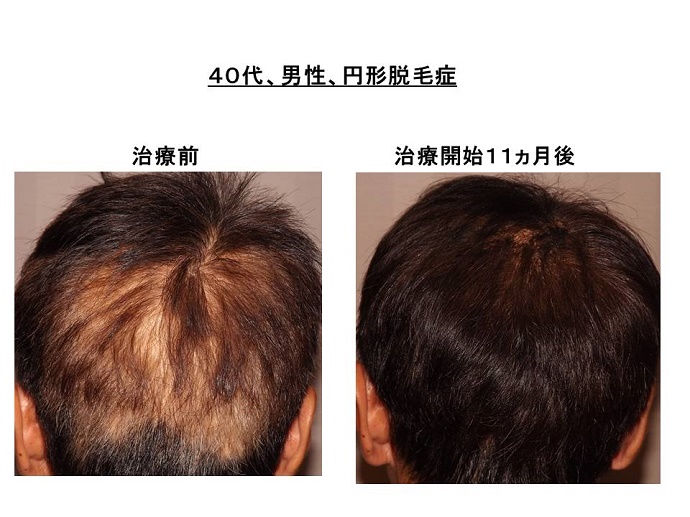 円形脱毛症　病院""